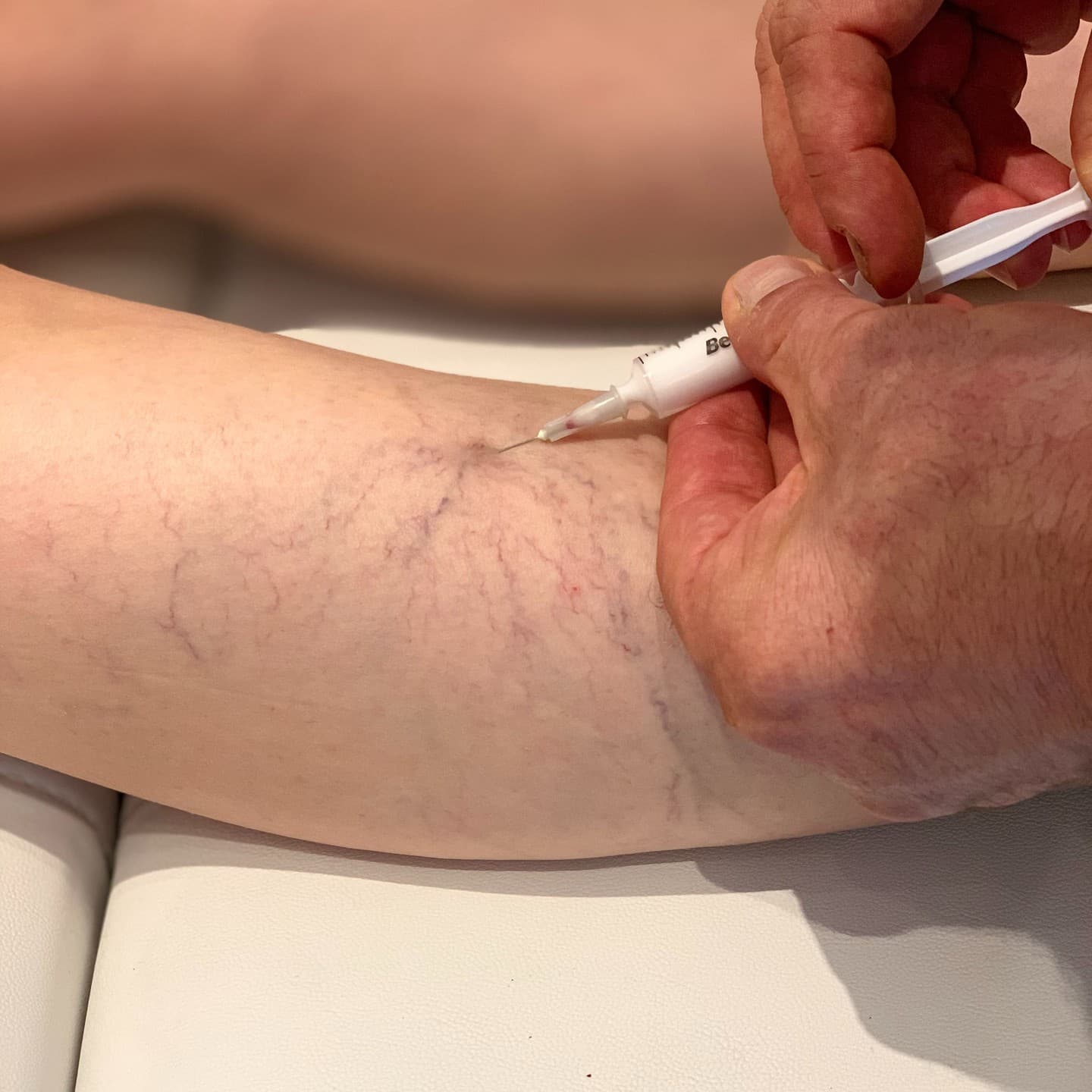 For years, varicose vein surgeries involved various incisions on the leg, groin, knee, and areas below the knee, often requiring the removal of veins using steel wires. Today, with advancements in technology, minimally invasive techniques like vein occlusion using medical glue, laser treatments to seal the vein, or sound wave therapy to eliminate varicose veins have taken center stage. These methods require no cutting or stitching and eliminate the need for anesthesia. Laser or RF treatments take just 10-15 minutes, and patients can resume their daily activities immediately after the procedure. One of the most notable advantages of these next-generation treatments is that they offer instant and lasting results.
